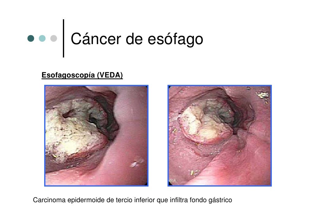 carcinoma epidermoide gastrico